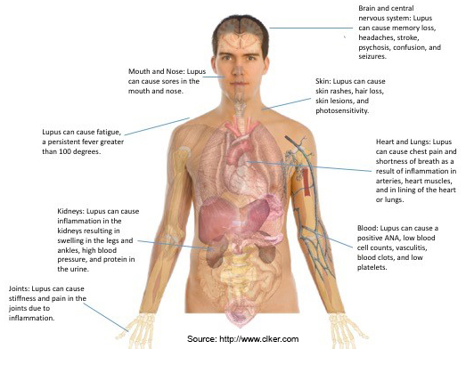 What causes a butterfly-shaped skin rash in people with lupus?