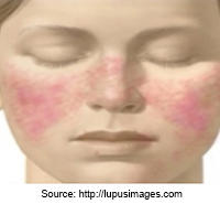 Acute-Cutaneous-Lupus1-sm.jpg