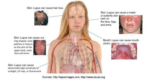 Cutaneous-Lupus-Erythematosus.jpg